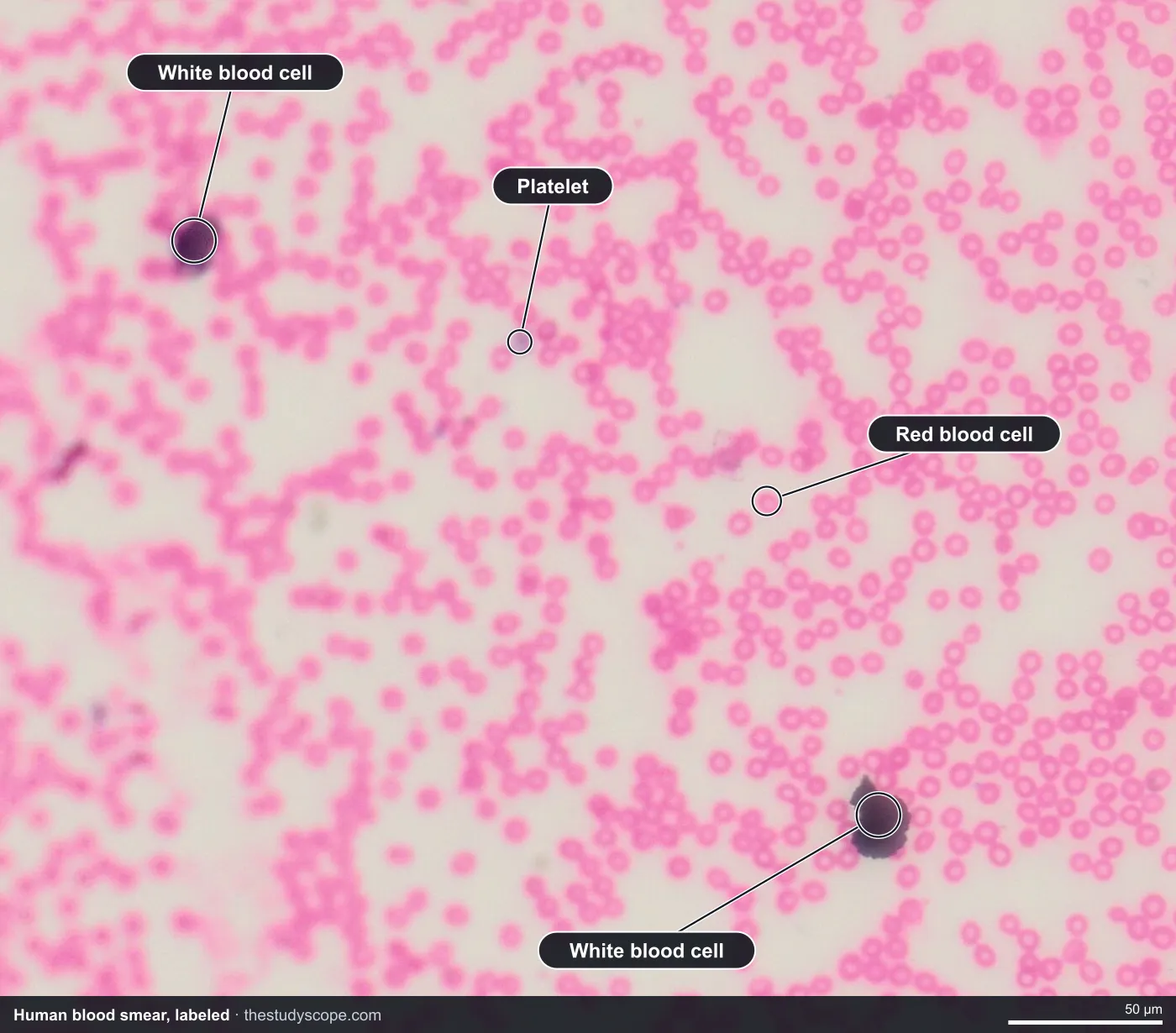 Labeled human blood smear under the microscope showing red blood cells, white blood cells and a platelet